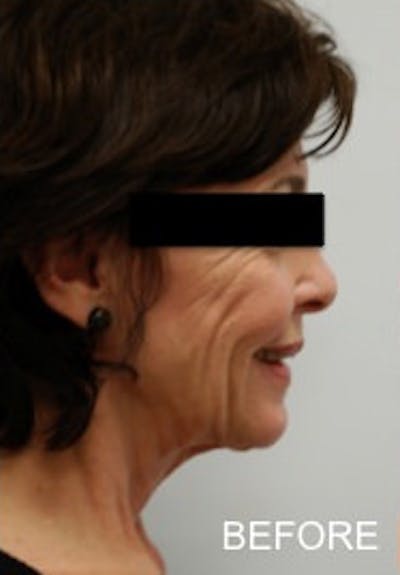 Facelift Before & After Gallery - Patient 334142 - Image 1