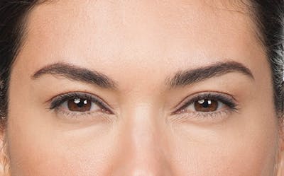BOTOX® Before & After Gallery - Patient 597735 - Image 2
