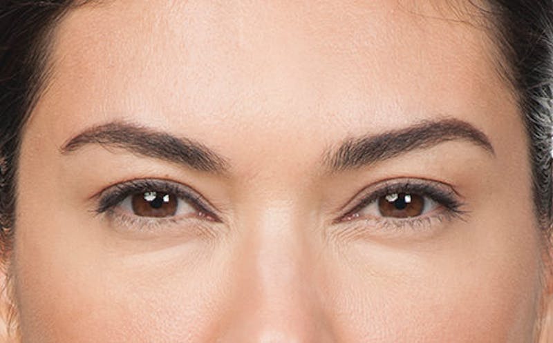BOTOX® Before & After Gallery - Patient 597735 - Image 2