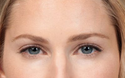 BOTOX® Before & After Gallery - Patient 387208 - Image 2