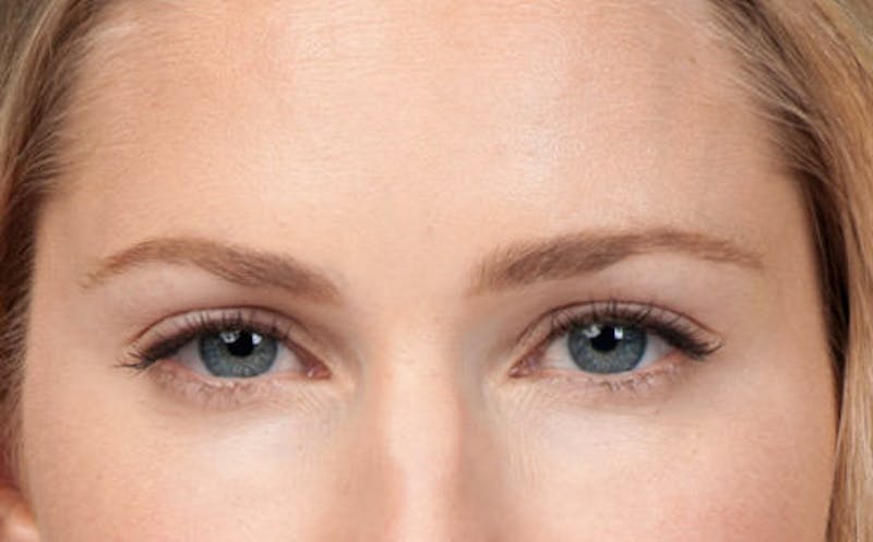 BOTOX® Before & After Gallery - Patient 387208 - Image 2