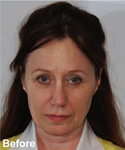 Blepharoplasty Before & After Gallery - Patient 112715 - Image 1