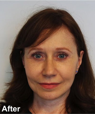 Blepharoplasty Before & After Gallery - Patient 112715 - Image 2