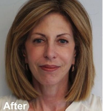 Blepharoplasty Before & After Gallery - Patient 349563 - Image 2