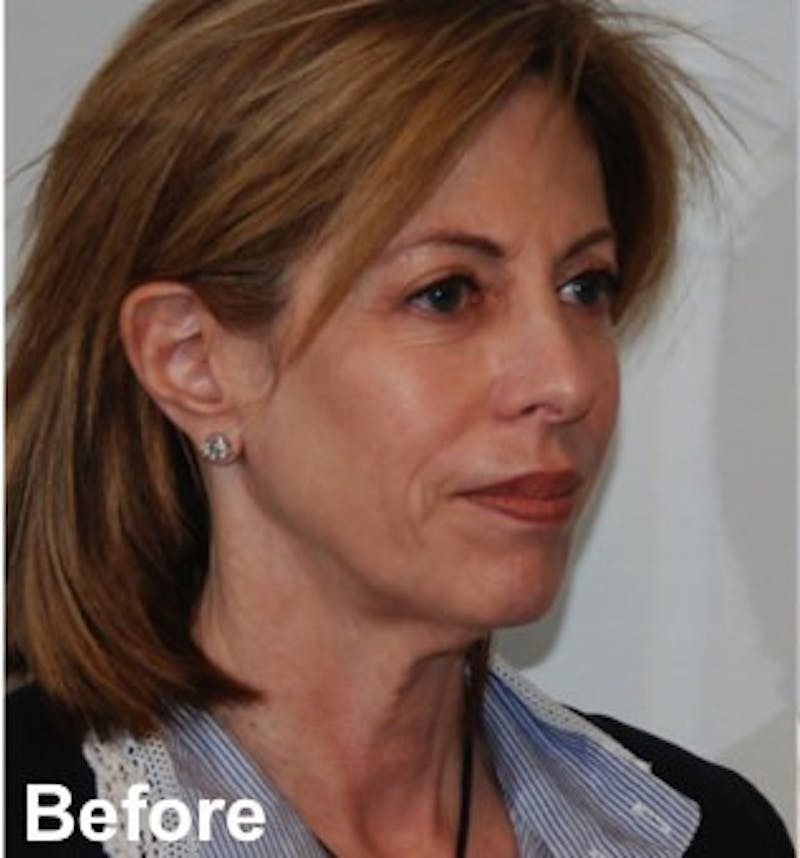 Blepharoplasty Before & After Gallery - Patient 349563 - Image 3