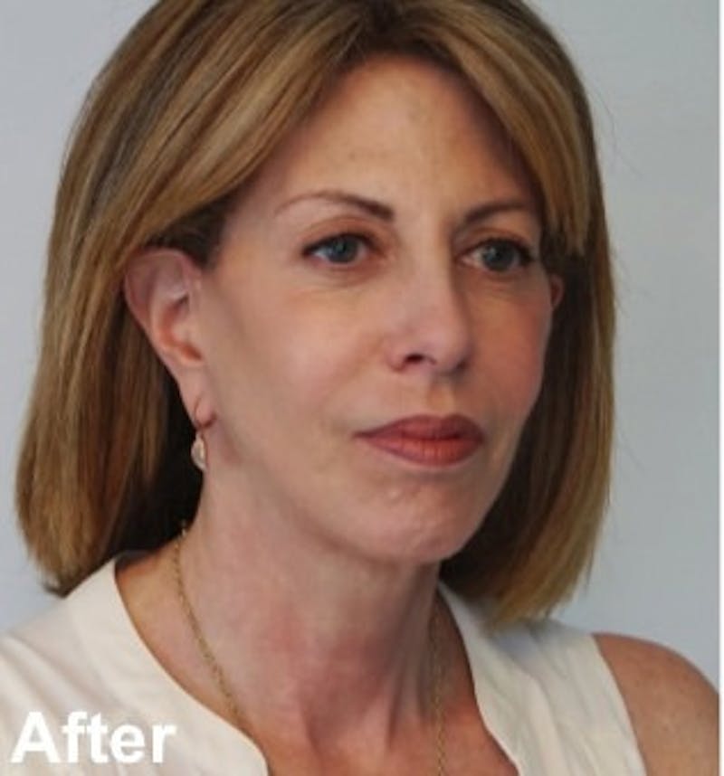 Blepharoplasty Before & After Gallery - Patient 349563 - Image 4