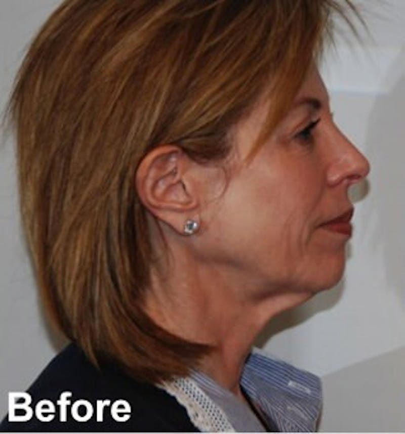Blepharoplasty Before & After Gallery - Patient 349563 - Image 5