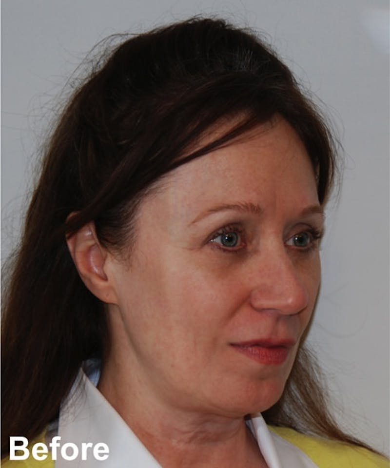 Neck Lift Before & After Gallery - Patient 182828 - Image 3
