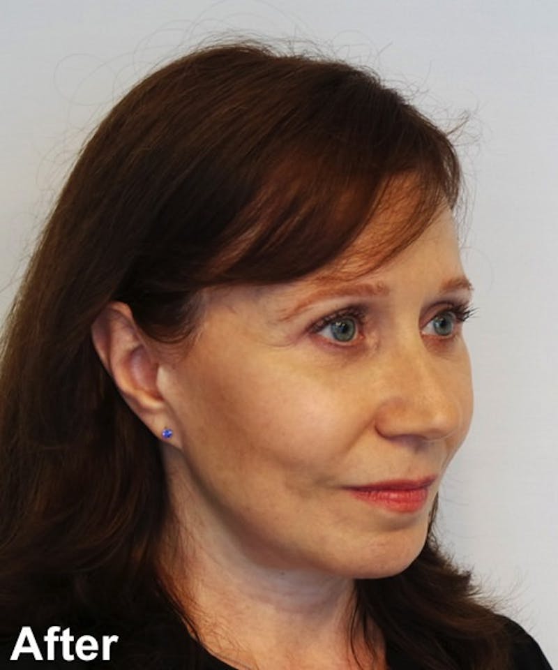 Neck Lift Before & After Gallery - Patient 182828 - Image 4