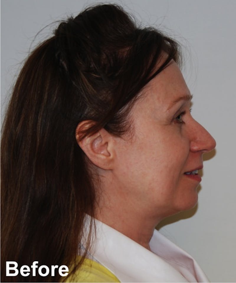 Neck Lift Before & After Gallery - Patient 182828 - Image 5