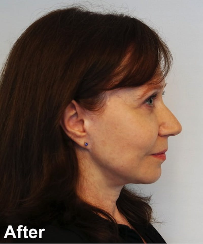 Neck Lift Before & After Gallery - Patient 182828 - Image 6