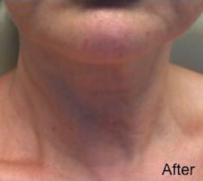 Sublative Fractional RF Before & After Gallery - Patient 335153 - Image 2