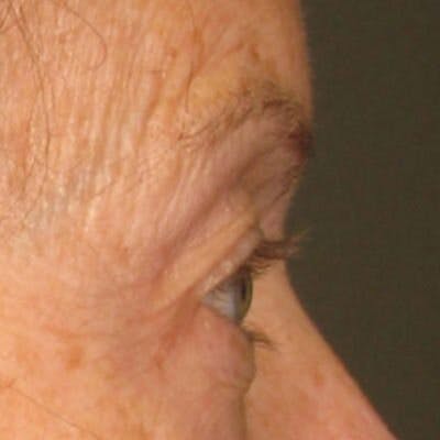 Ulthera Before & After Gallery - Patient 268633 - Image 1