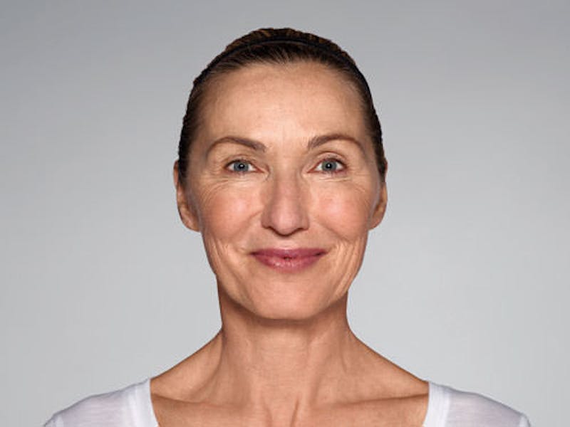 Restylane Refyne Before & After Gallery - Patient 134372 - Image 3