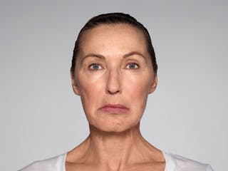 Restylane Refyne Before & After Gallery - Patient 134372 - Image 6
