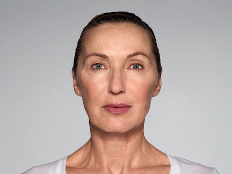 Restylane Refyne Before & After Gallery - Patient 134372 - Image 10
