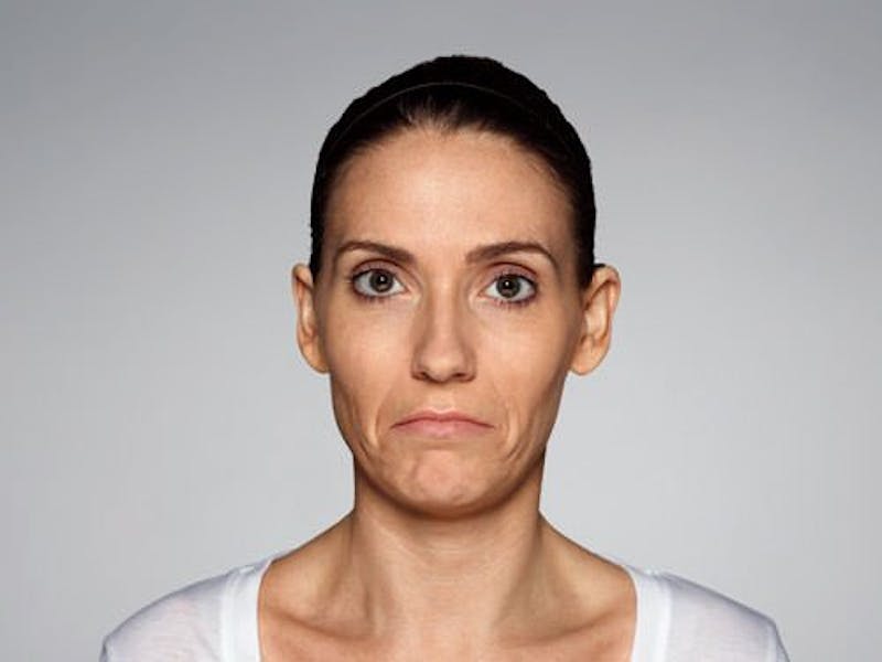 Restylane Defyne Before & After Gallery - Patient 216263 - Image 5