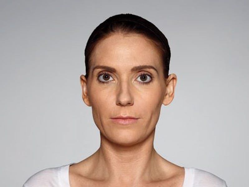 Restylane Defyne Before & After Gallery - Patient 216263 - Image 10