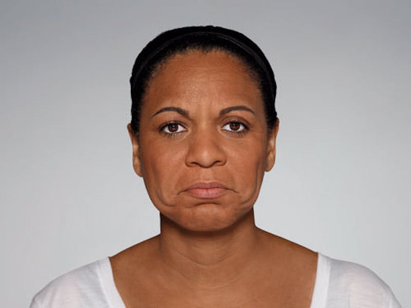 Restylane Defyne Before & After Gallery - Patient 123437 - Image 6