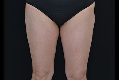 BTL Vanquish Before & After Gallery - Patient 915167 - Image 1