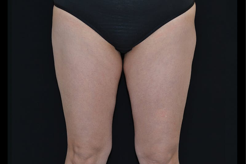 BTL Vanquish Before & After Gallery - Patient 915167 - Image 1