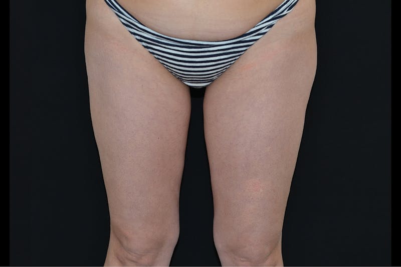 BTL Vanquish Before & After Gallery - Patient 915167 - Image 2