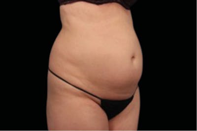 BTL Vanquish Before & After Gallery - Patient 161013 - Image 1