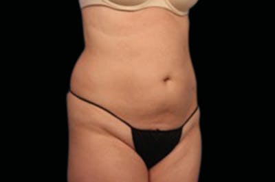 BTL Vanquish Before & After Gallery - Patient 161013 - Image 2