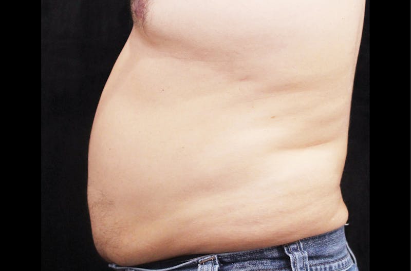 BTL Vanquish Before & After Gallery - Patient 417204 - Image 1