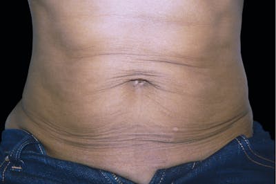 BTL Exilis Ultra Before & After Gallery - Patient 312093 - Image 1