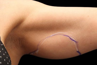 BTL Exilis Ultra Before & After Gallery - Patient 416836 - Image 1