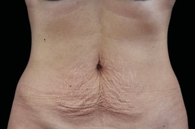 Emtone Before & After Gallery - Patient 233892 - Image 1