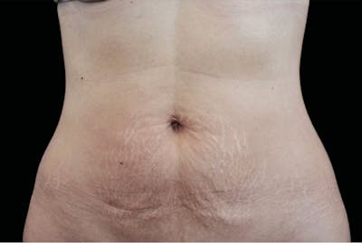 Emtone Before & After Gallery - Patient 233892 - Image 2