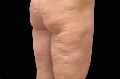 Emtone Before & After Gallery - Patient 214545 - Image 1