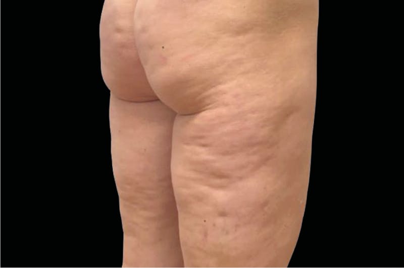 Emtone Before & After Gallery - Patient 214545 - Image 1