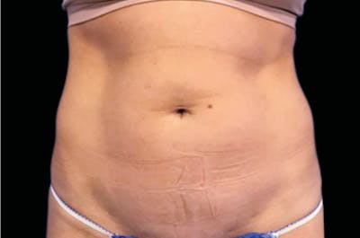 Emsculpt Neo Before & After Gallery - Patient 202078 - Image 1