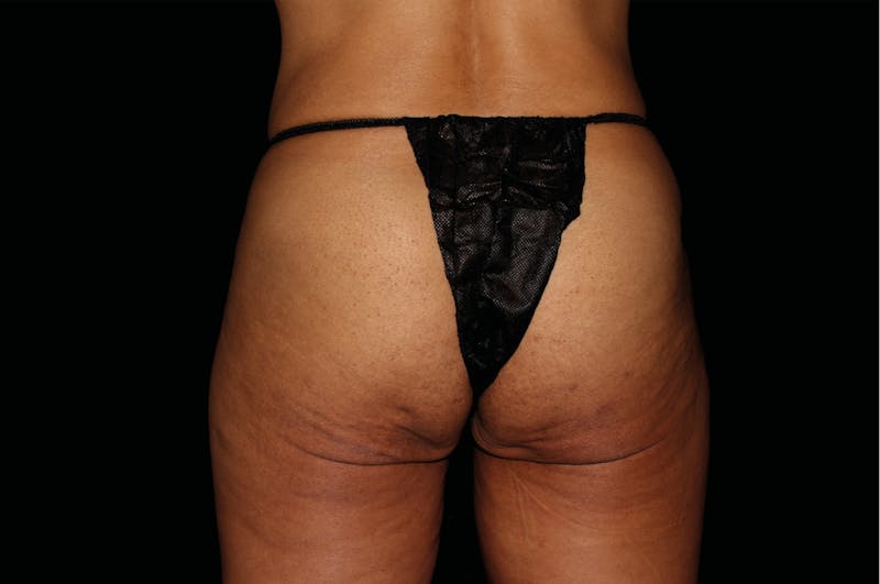 Emsculpt Neo Before & After Gallery - Patient 121266 - Image 1