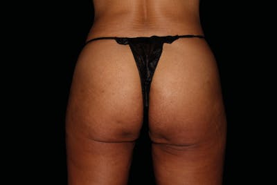 Emsculpt Neo Before & After Gallery - Patient 121266 - Image 2