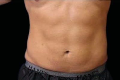 Emsculpt Neo Before & After Gallery - Patient 426036 - Image 2