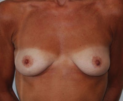 Breast Lift with Augmentation Before & After Gallery - Patient 248017 - Image 1