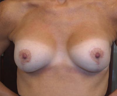 Breast Lift with Augmentation Before & After Gallery - Patient 248017 - Image 2
