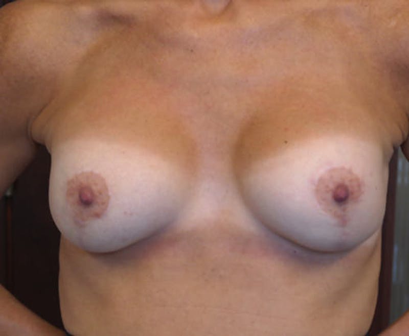 Breast Lift with Augmentation Before & After Gallery - Patient 248017 - Image 2