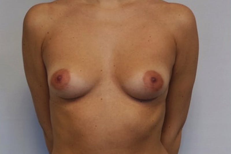 Breast Lift with Augmentation Before & After Gallery - Patient 425118 - Image 1