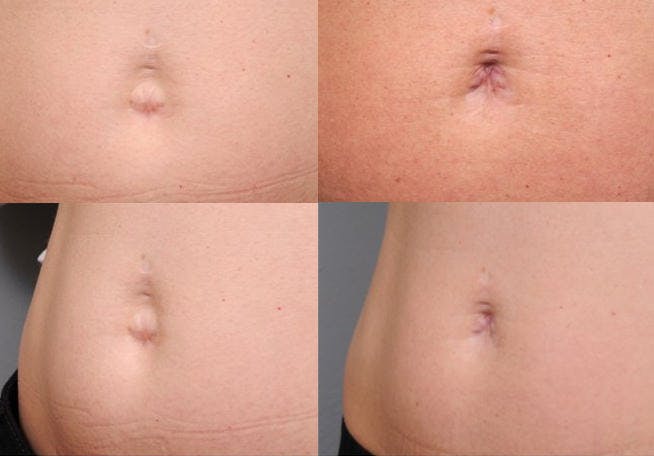 belly buttons