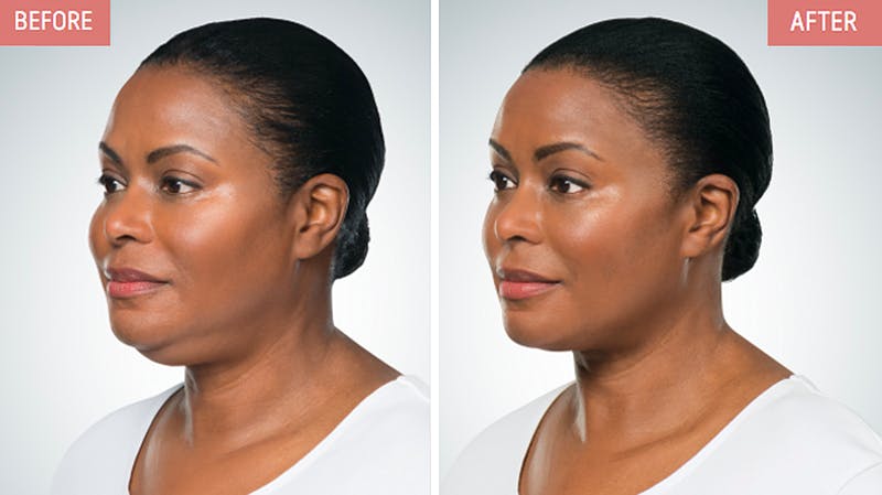 kybella before and after