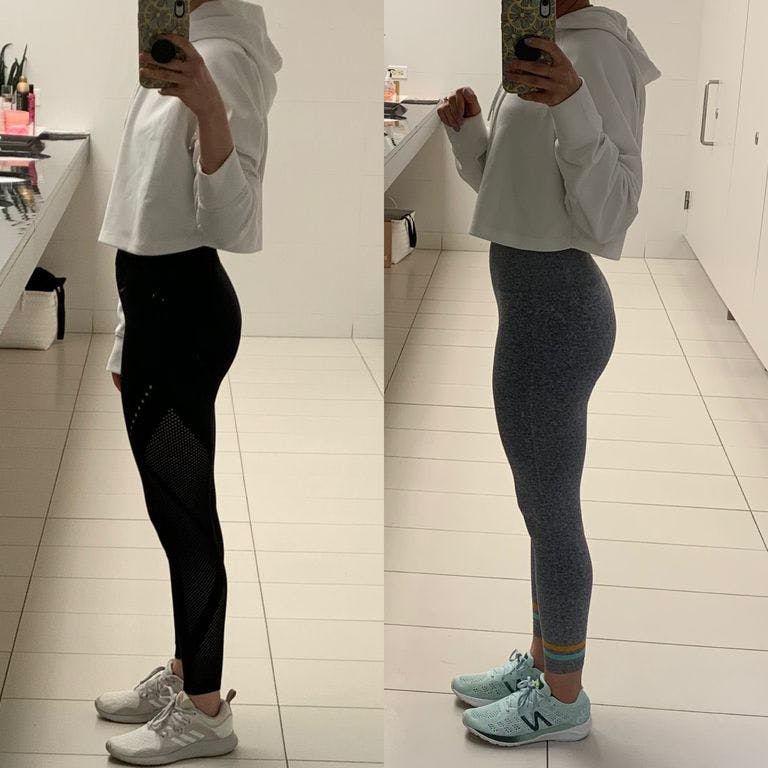 emsculpt results