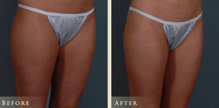 mommy makeover results