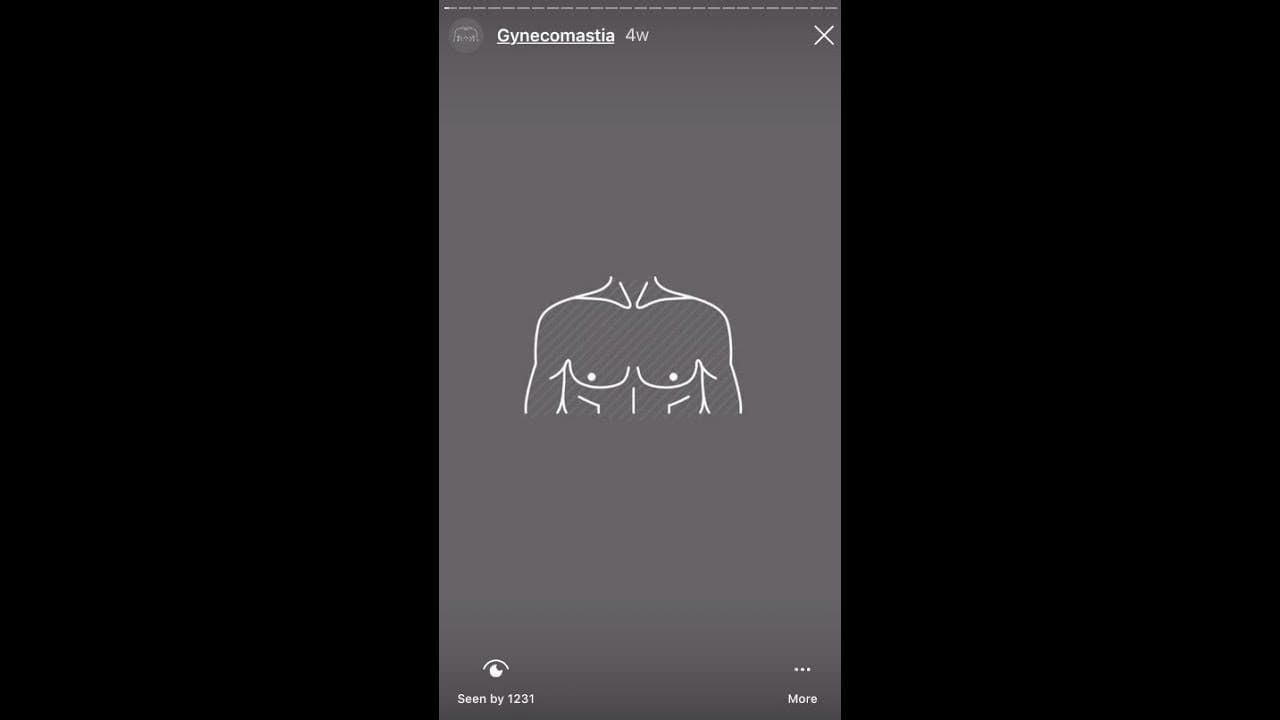 gynecomastia youtube video
