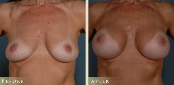 Breast-Augmentation-UU-FRONT
