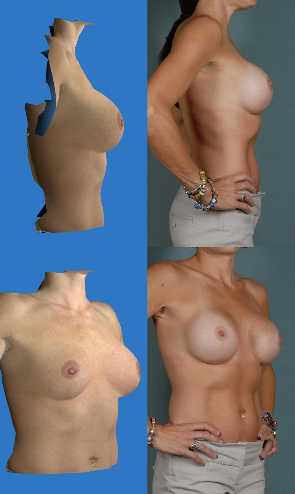 Denver-breast-augmentation-photos_3d
